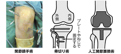 人工関節手術